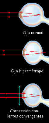 Lentes convergentes e hipermetropía