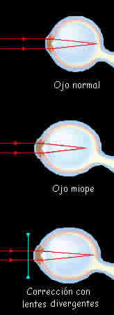 Lentes divergentes y miopía